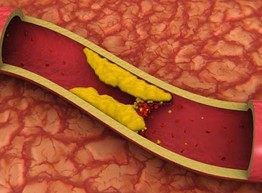 Что нужно знать о холестерине